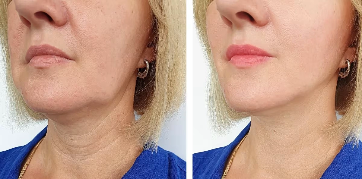 Resultados: Antes y después del tratamiento de radiofrecuencia Resultados: Antes y después del tratamiento de radiofrecuencia